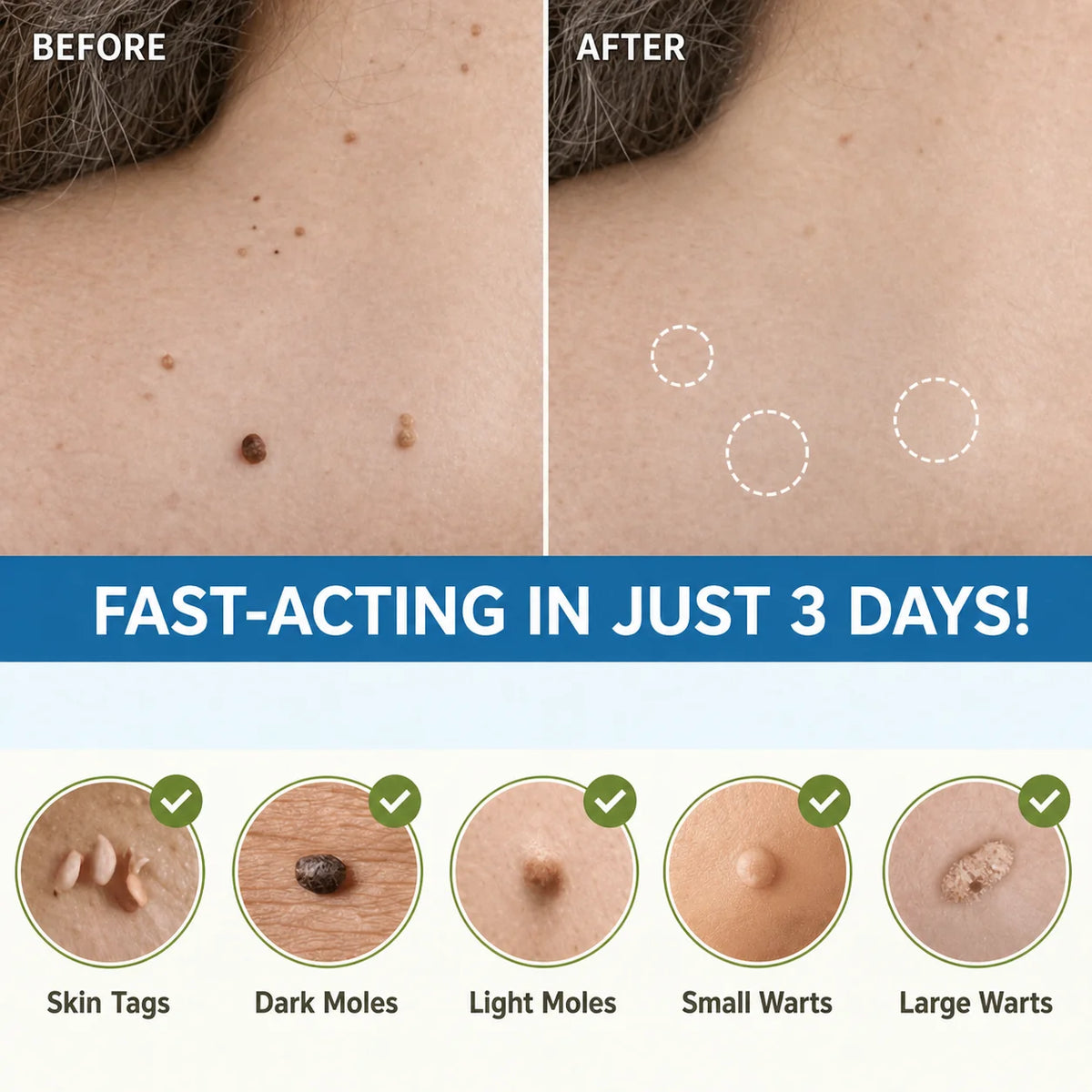 Skin Tag Remover Patches Painless Natural Skin-Friendly