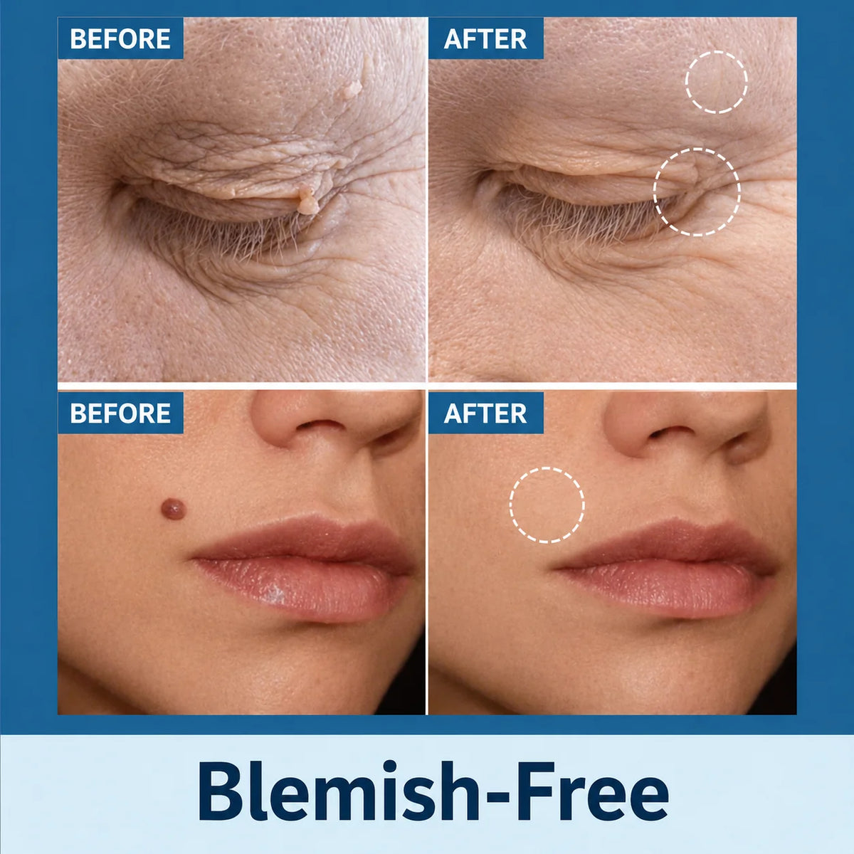 Skin Tag Remover Patches Painless Natural Skin-Friendly